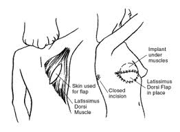 A diagram showing the skin from back muscle taken for a breast reconstruction, and where it would be attached in front.